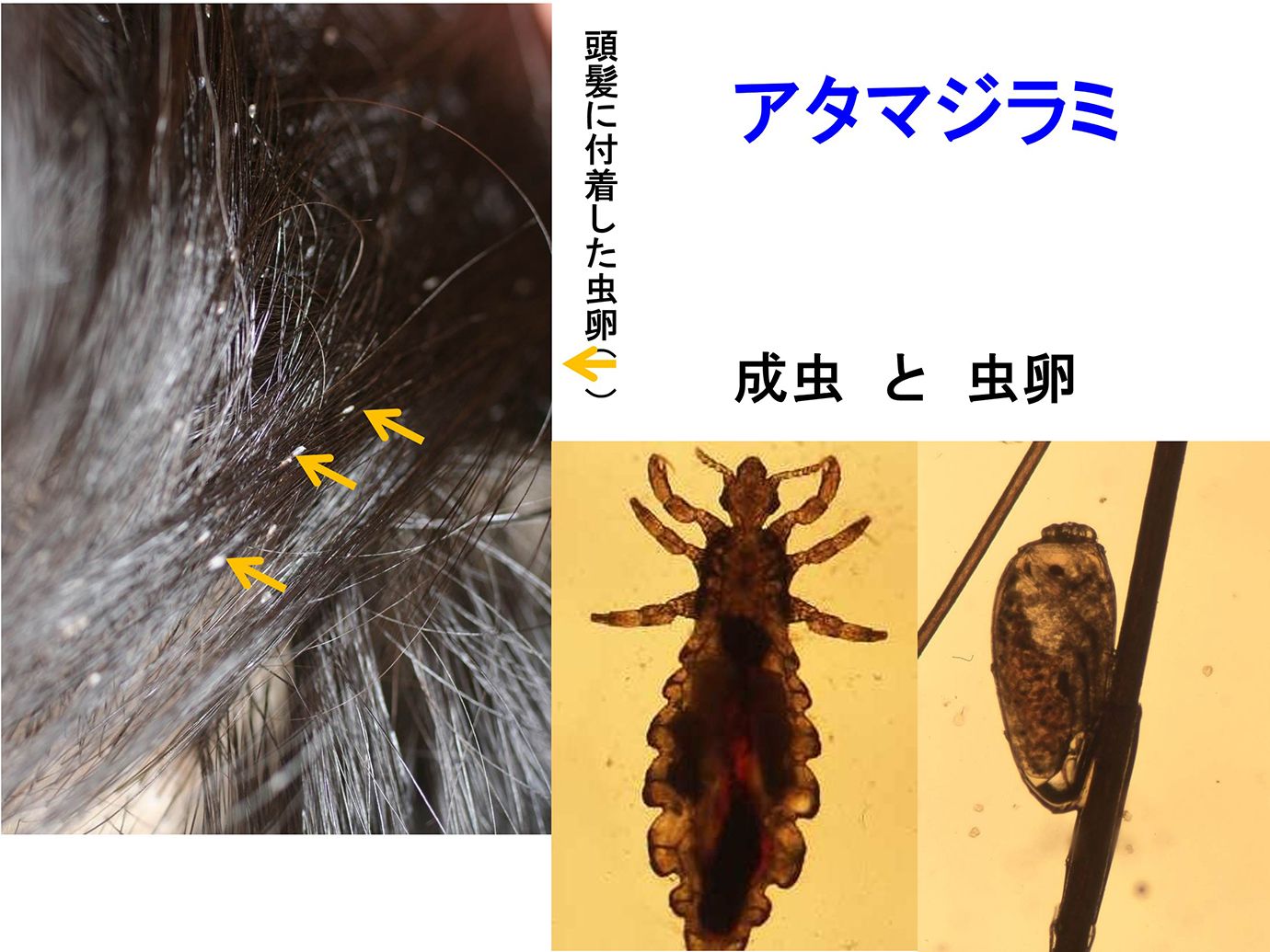 アタマジラミ 放置 すると